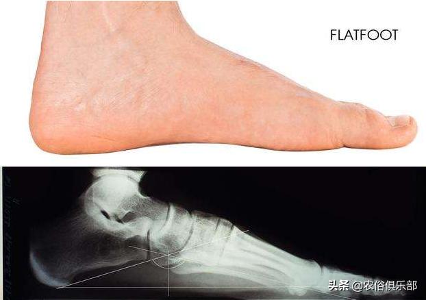 农村俗语：脚板下无空，是个老长工！平板脚真的不好么？