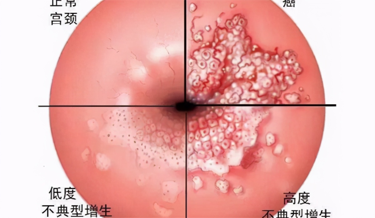hpv感染合并宫颈息肉,hpv感染合并慢性宫颈炎