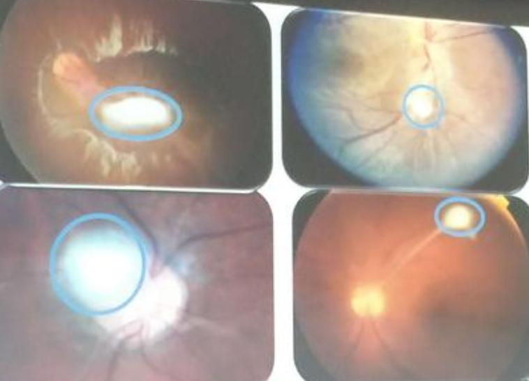 郭碧婷试管生孩子吗,郭碧婷是不是很幸运嫁了豪门