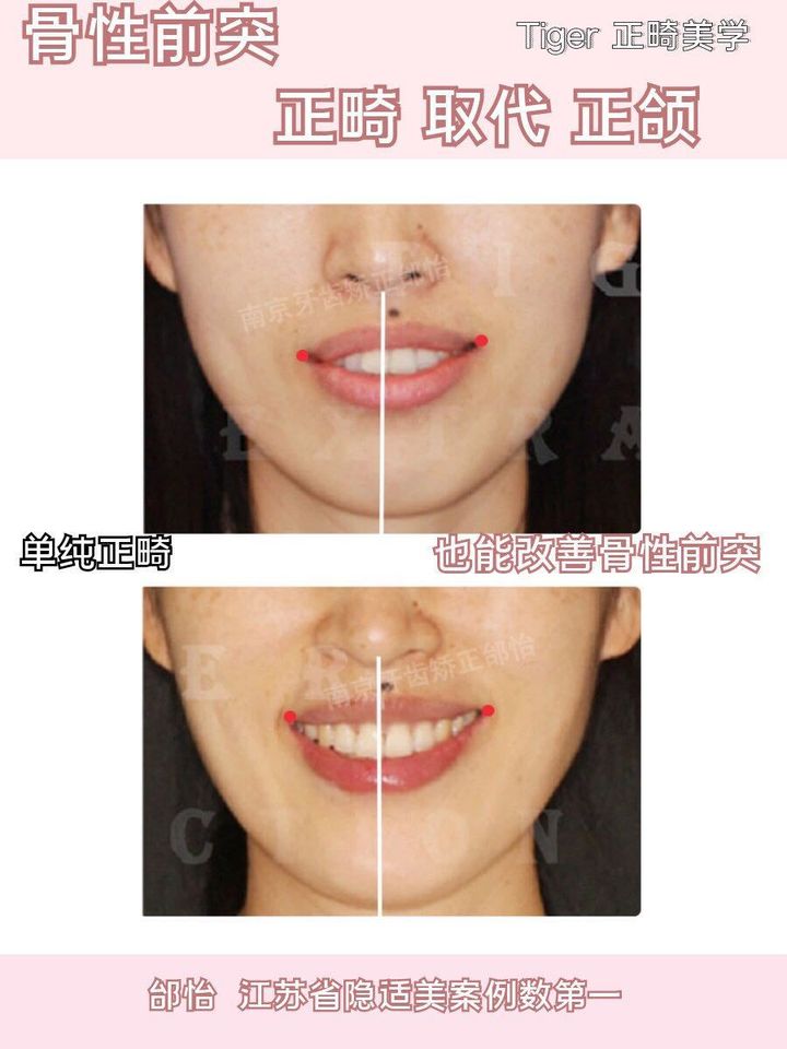 隐适美矫正网上为什么这么便宜,隐适美矫正会不会比预期的快