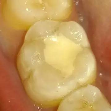 牙齿有银色充填物,需要注意什么?葉子口腔科普