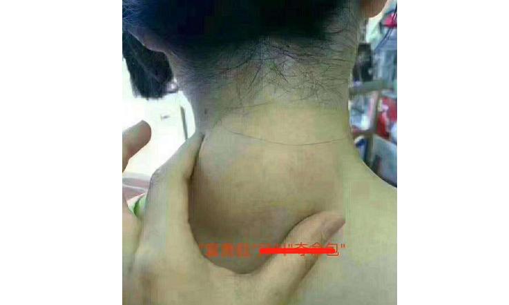 脖子后边的富贵包该怎么治疗,脖子后面的富贵包咋治呢