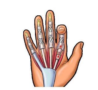 腱鞘炎手指解说图,腱鞘炎介绍