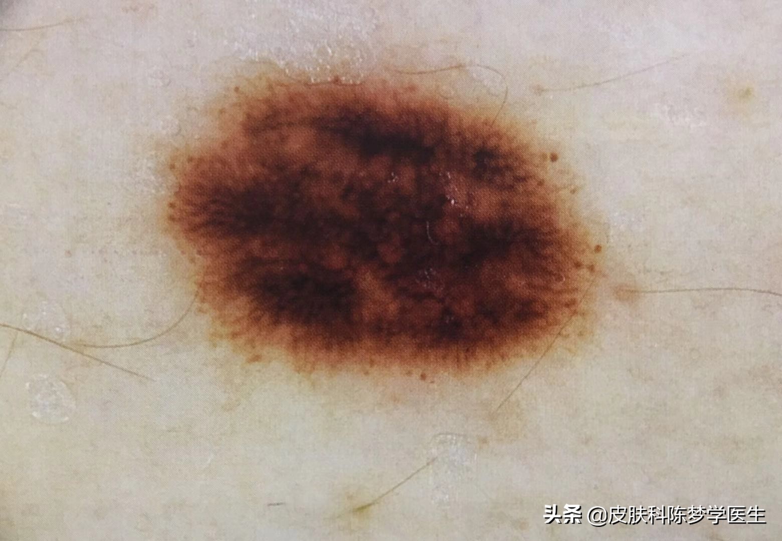 激光点痣真的会导致痣发生癌变吗,脸上有痣能激光点痣吗