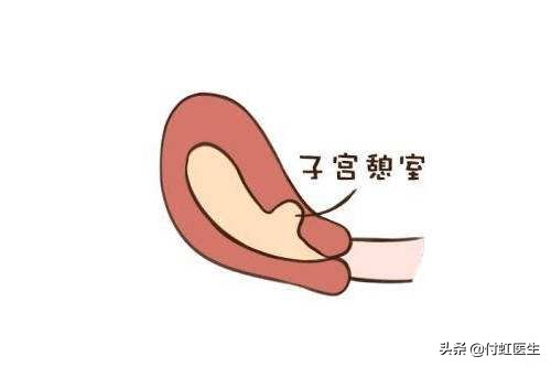 剖宫产后2年B超发现子宫里面出了“套间”，影响我要二宝吗？