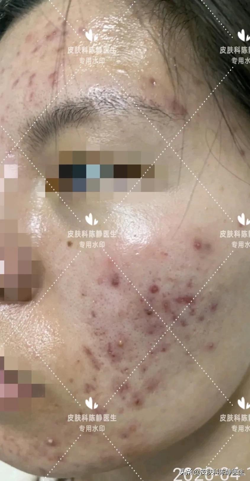 暗疮和青春痘有什么区别,痤疮青春痘常见十八问