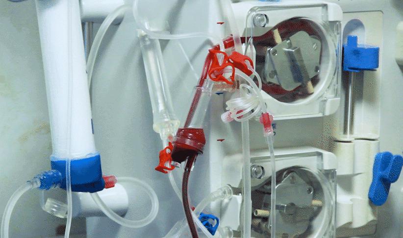 类风湿患者做血液过滤好吗,类风湿病人做透析治疗有用吗