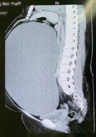 15岁少年腹中20公斤巨瘤,39岁女子腹中30斤巨型肿瘤