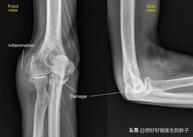 胳膊用力过度后胳膊肘疼怎么回事,胳膊肘劳累过度关节疼痛用什么药