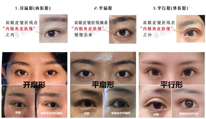双眼皮改单眼皮案例,扇形双眼皮改平行双眼皮多少钱