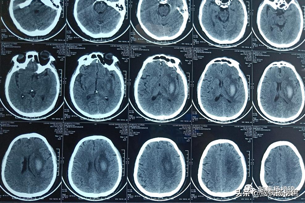 高处坠落4-6小时导致脑出血,高空作业会不会引起脑出血
