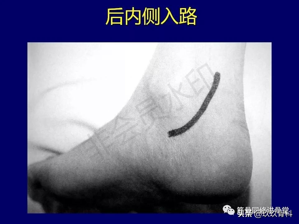 距骨骨折的治疗原则,距骨骨折如何调理