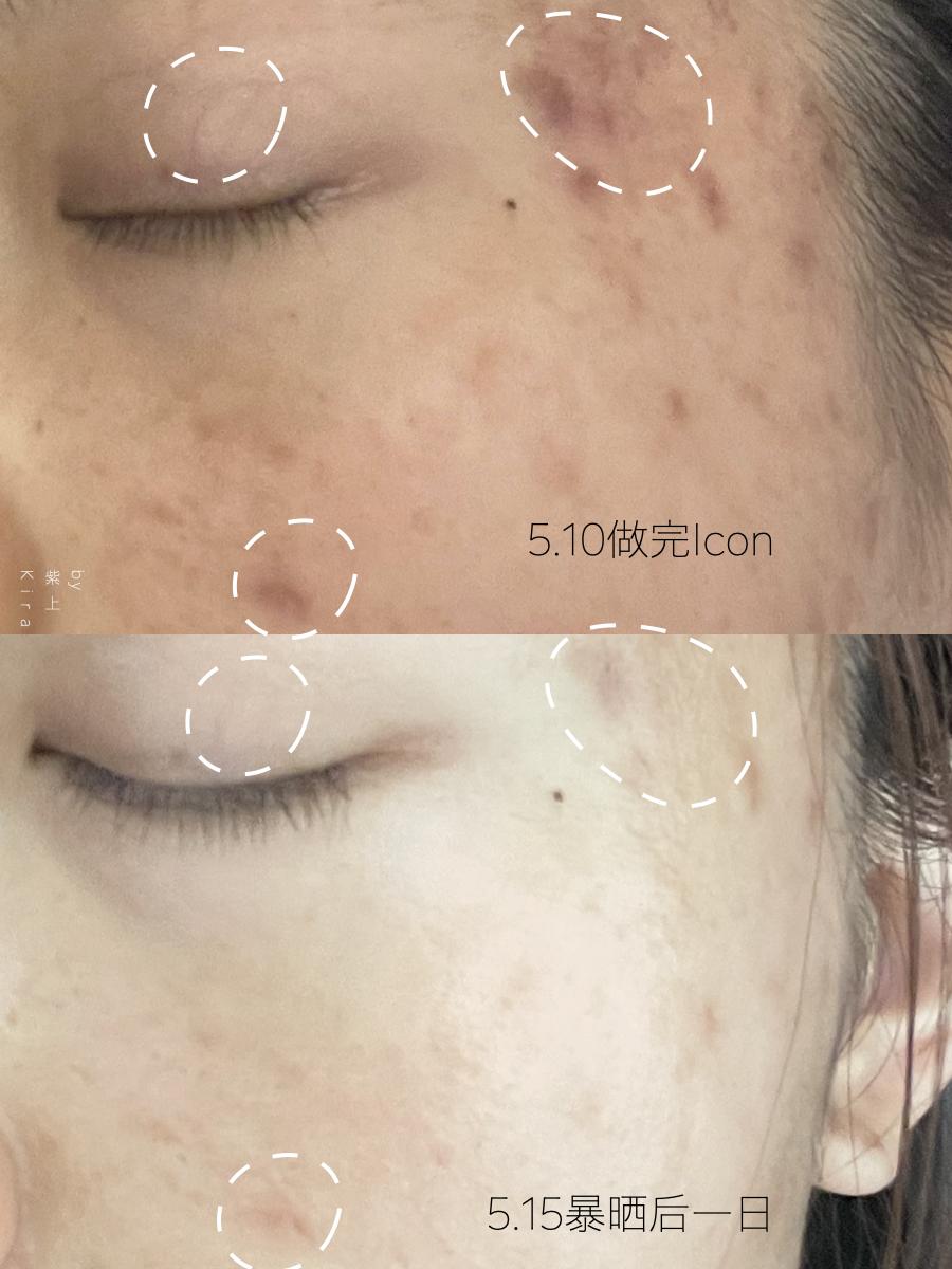 为了亲眼看到龚俊我的脸差点毁了，做了光子嫩肤，护理必须要上心