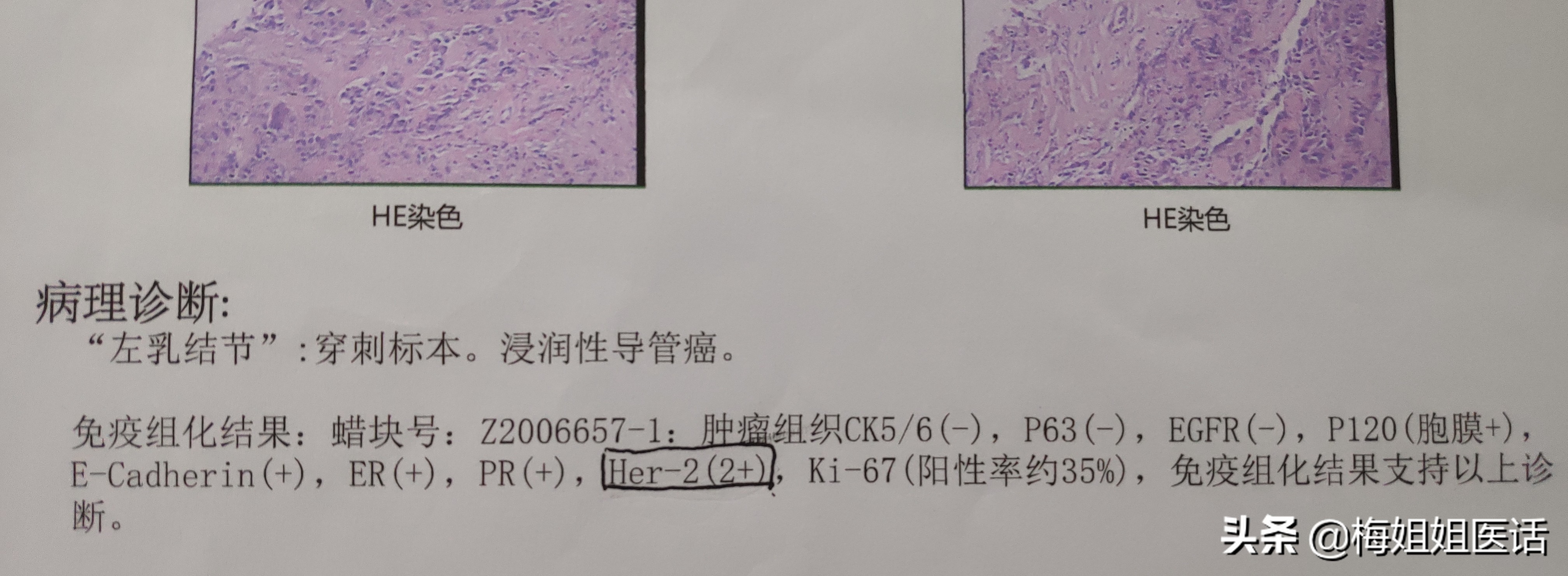 乳腺癌化疗后需要吃什么中成药,乳腺癌内分泌治疗在化疗前还是后