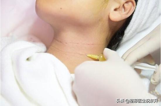 颈纹可以用颈纹霜去除吗,你的颈纹在哪里