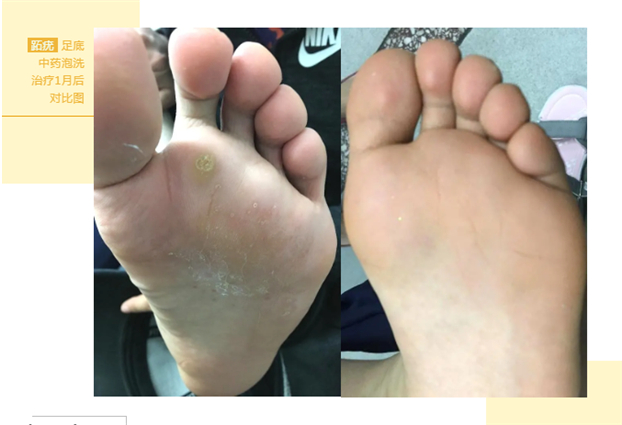 跖疣发生在足底的寻常疣咋治疗,治疗足底疣偏方