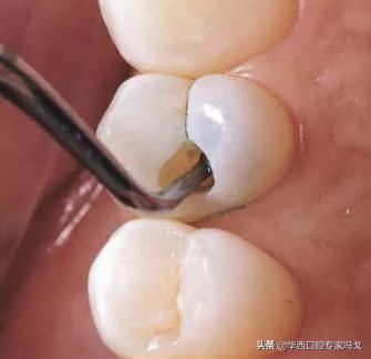 牙齿龋坏补牙多少钱,门牙龋坏了建议补牙还是做牙冠