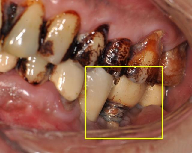种植牙1万多嫌太贵，“3000元的种植牙”你敢种吗？