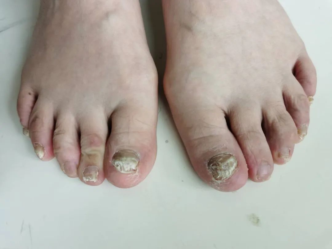 家里治脚气最好的方法,家庭治脚气的最好方法