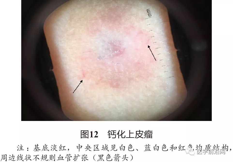 面部常见皮肤病皮肤镜诊断专家共识全文发布