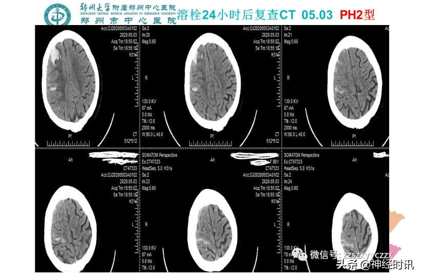静脉溶栓怎么引起的,静脉相关并发症的预防及处理