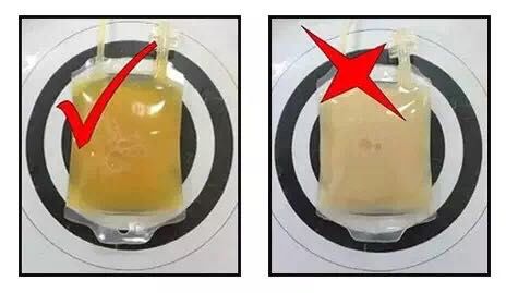 小伙子，你的血好像有点“油”!