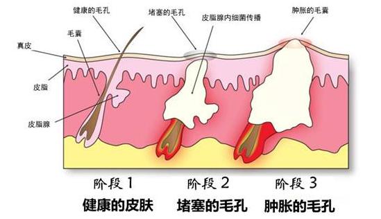零毛孔让你的皮肤光滑细腻,教你一招搞定毛孔