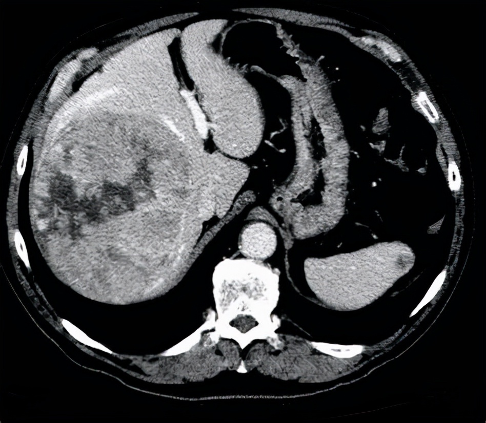 50多岁水肿是什么原因引起的,突然发胖水肿厉害什么原因