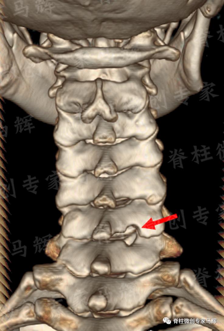 脊椎狭窄压迫神经腿疼怎么治疗,神经根痛上肢麻木怎么康复