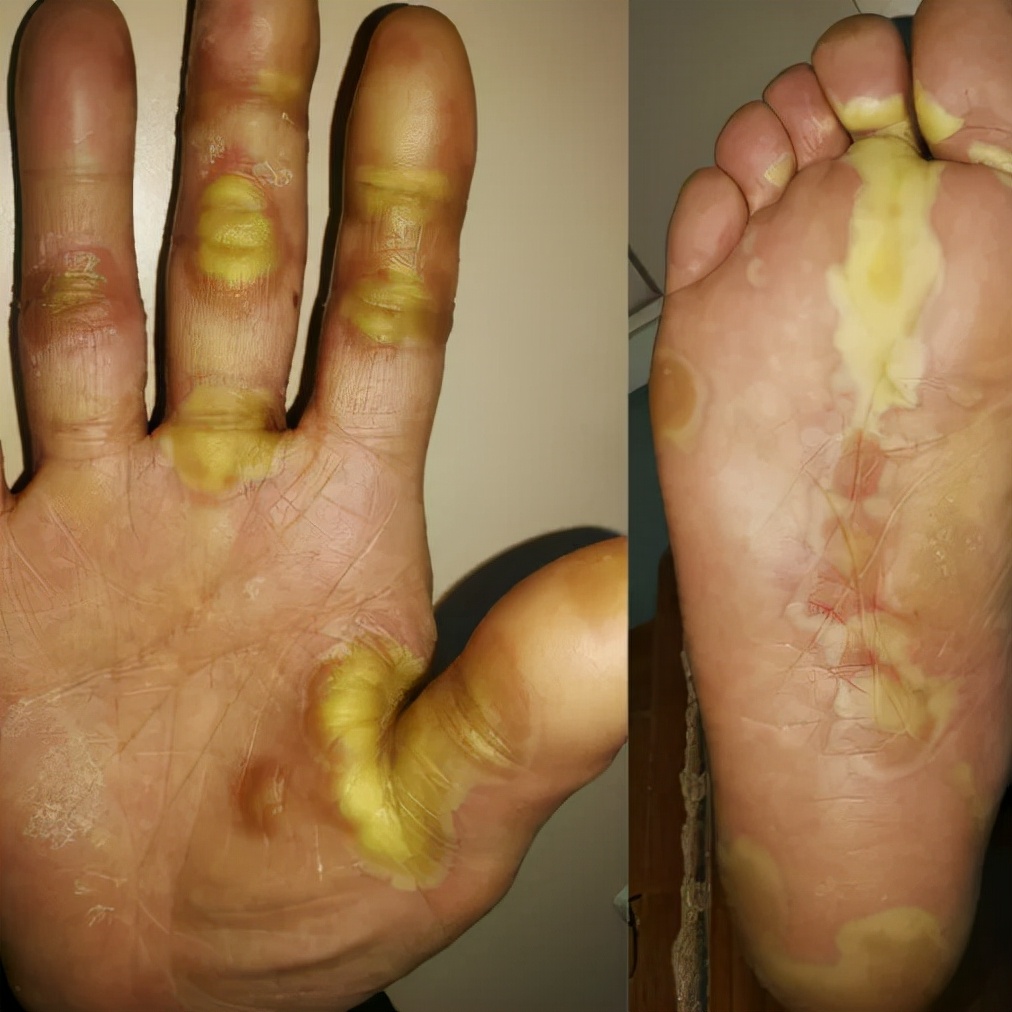 靶向药物导致皮疹的护理,靶向药造成的肌肉损伤能自愈吗