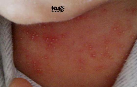 湿疹和热疹的处理方法区别,湿疹跟热疹怎么区分如何处理