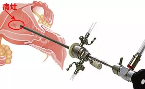 宫腔镜检查全过程跟手术有区别吗,宫腔镜三个孔和四个孔的区别