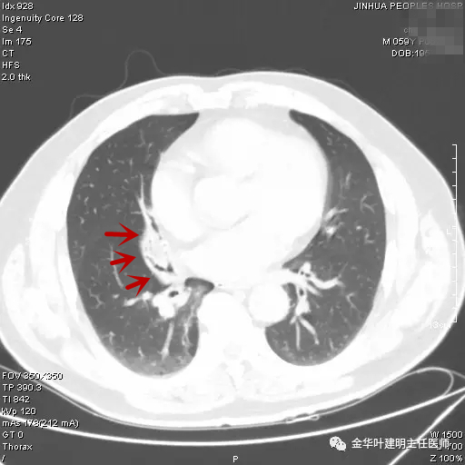 警惕反复发烧,警惕反复感染