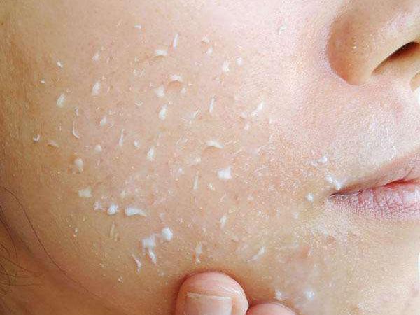 教你如何去除闭合性粉刺，分分钟学会！