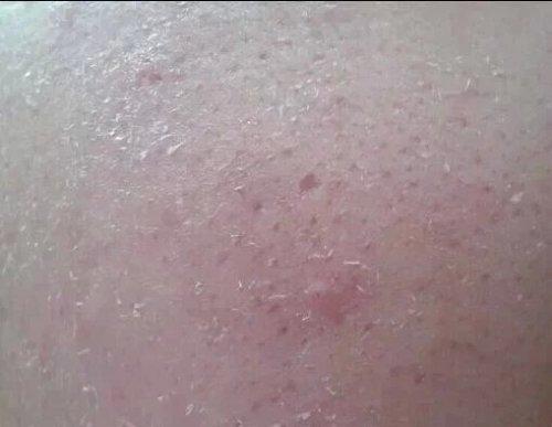 皮肤换季过敏干燥和痒护肤品,过敏干燥的脸部用哪种护肤品