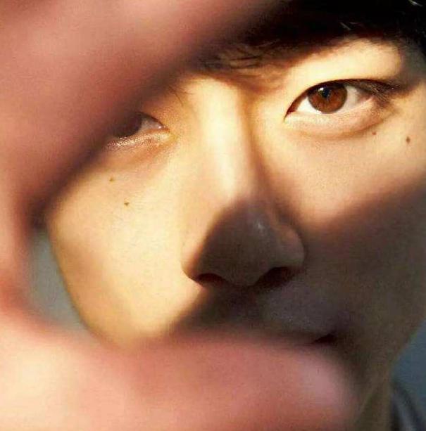 男生小眼睛割双眼皮前后对比,男生割双眼皮多久恢复自然