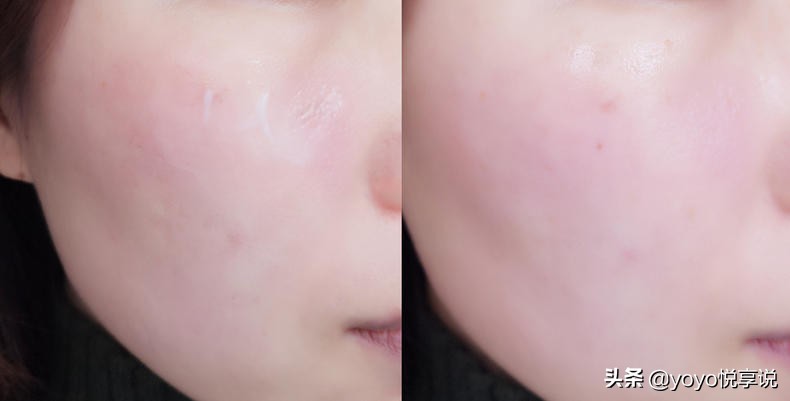 开春脸部刺痛，泛红怎么办？敏感肌换季得有一件神器