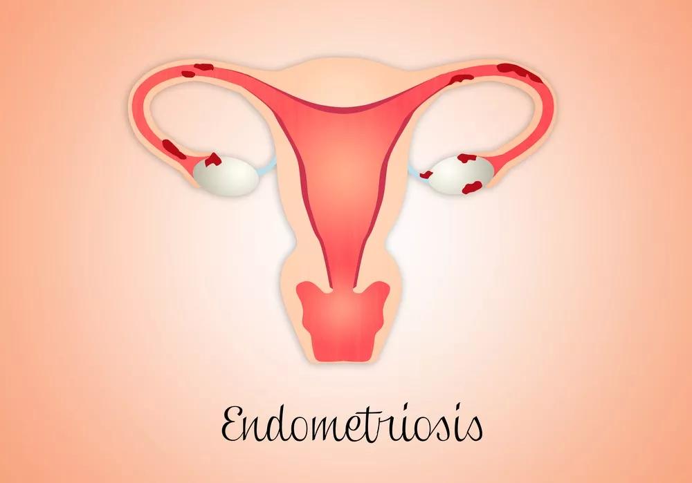 子宫内膜异位症生活中注意哪些,子宫内膜异位怎么管理