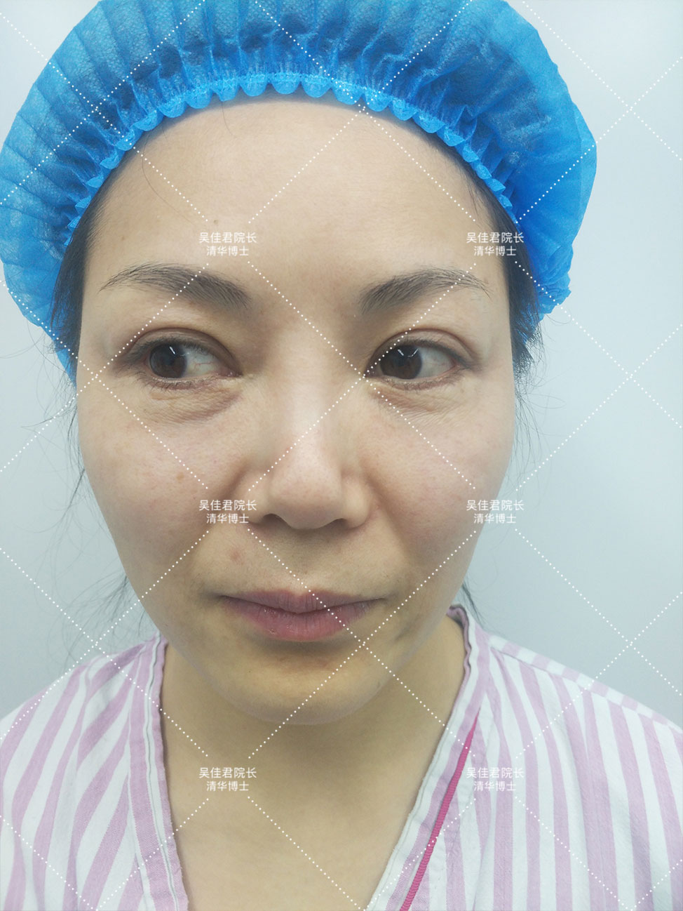 小拉皮术后恢复多久,小拉皮术后一个月发红