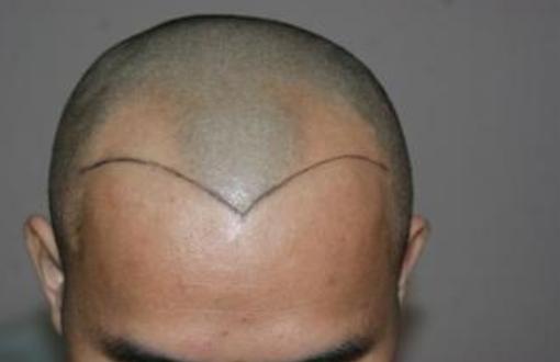 植发后脱落头发根部黑,几年前植发现在原来的头发掉了