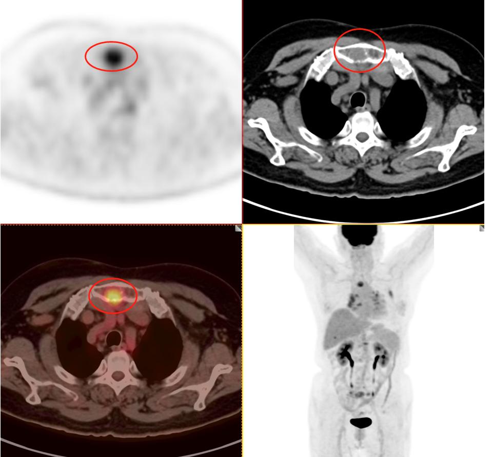 肺结节检查是薄层ct还是三维重建,肺结节检查用什么ct