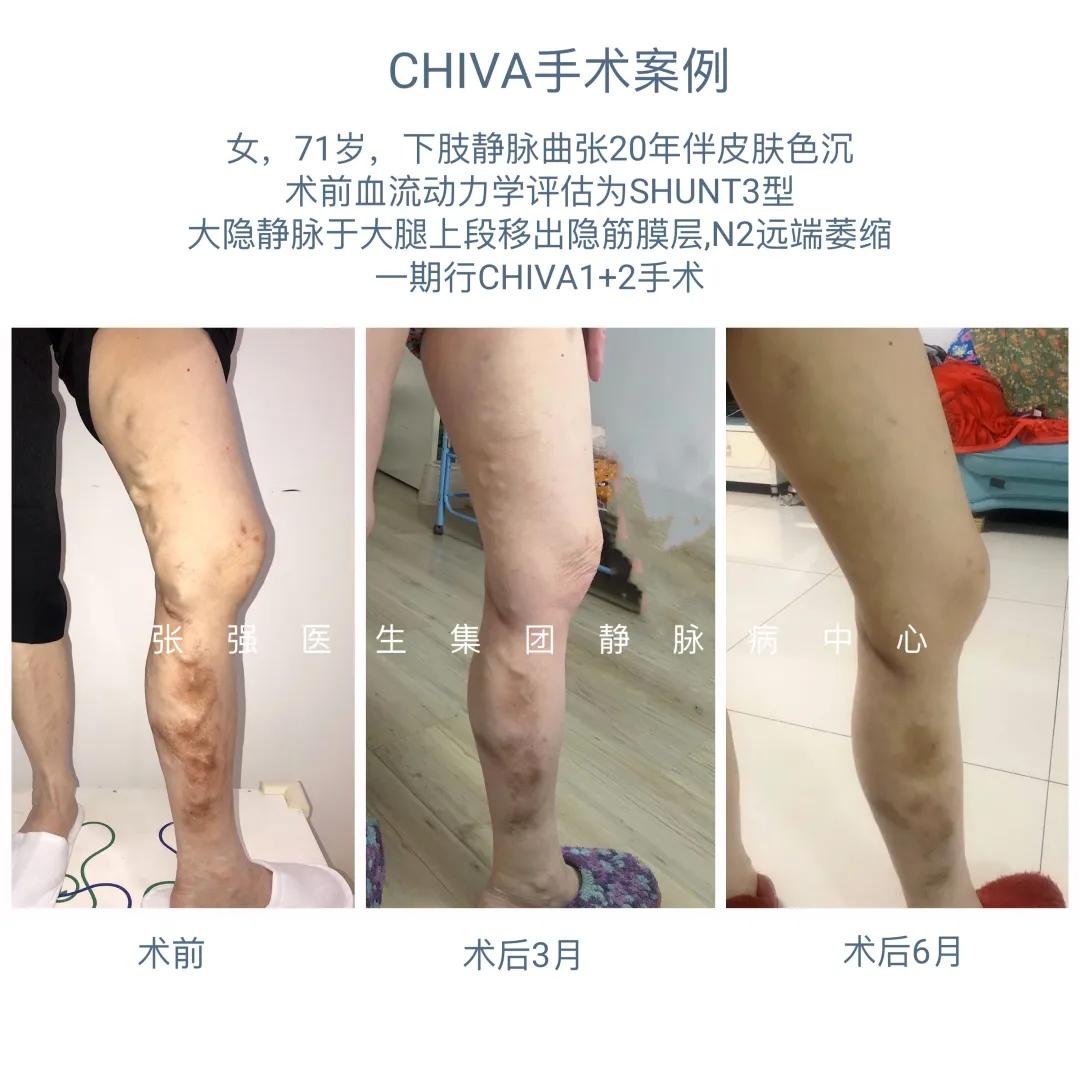 chiva治疗下肢静脉曲张价格,chiva治疗静脉曲张