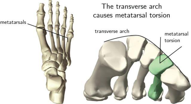 小脚趾磨出茧是因为拇外翻吗,怎么知道脚底长的是茧还是疣