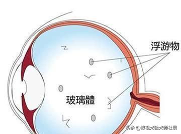 弄得我尴尬症都犯了：眼前出现很多小黑点飘来飘去！飞蚊症？