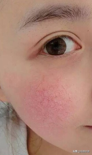 纬誉时光定格原液为你解答*血丝红**出现的原因