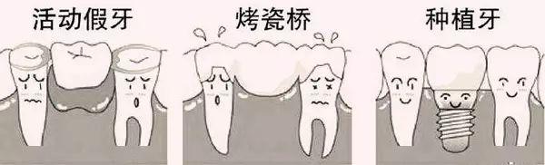 连缺三颗下门牙怎么镶好,明明缺一颗牙为什么要套三颗