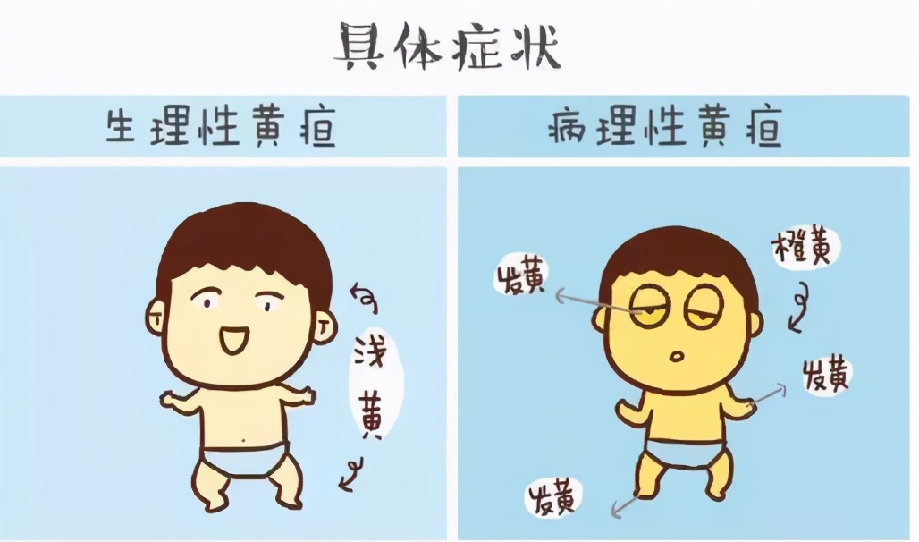 宝宝上午黄疸高下午减轻,黄疸早上高下午降