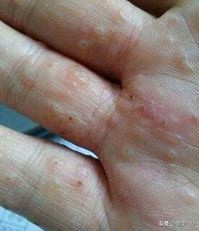 手部季节性脱皮有哪几种,手部脱皮严重是什么样的