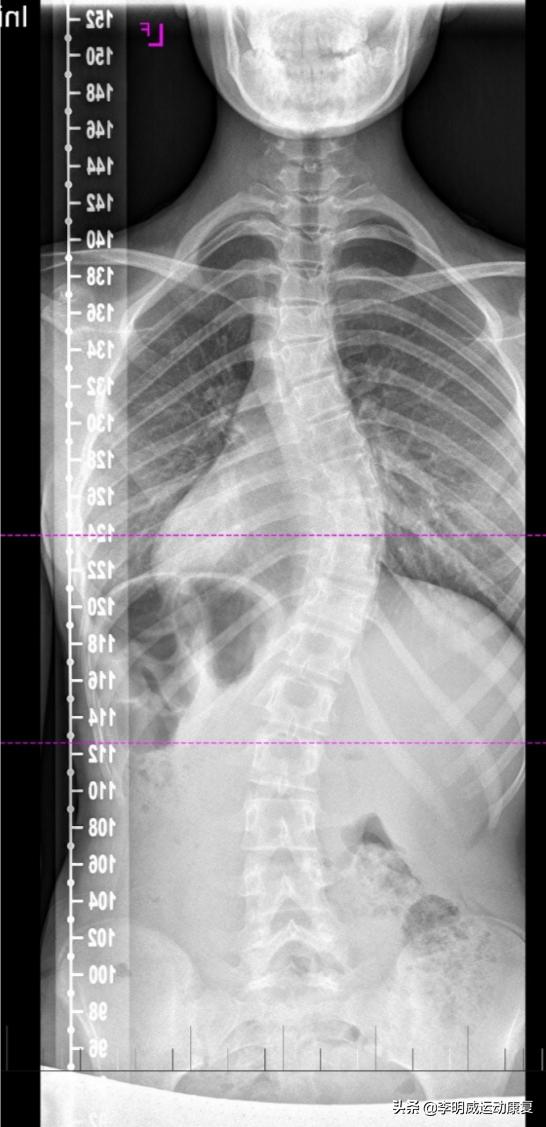 脊柱侧弯视频完整版,脊柱侧弯最好的医院