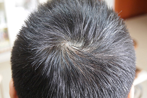 孩子“少白头”怎么办？这些方面千万要注意